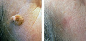 Usuwanie zmian skórnych laserem - efekty