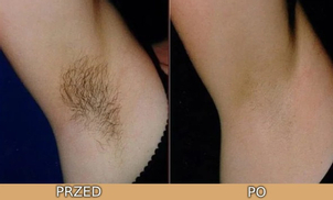 Depilacja laserowa - efekty