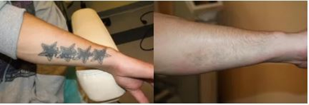 Laserowe usuwanie tatuażu - efekty