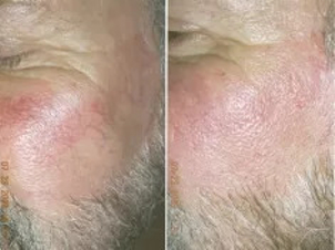 Zamykanie naczynek laserem