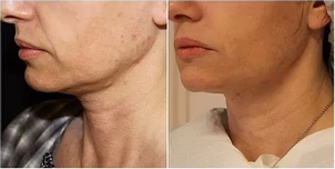 Lifting podbródka metodą termoliftingu