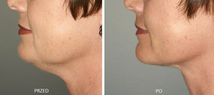 Liposukcja podbródka - przed i po