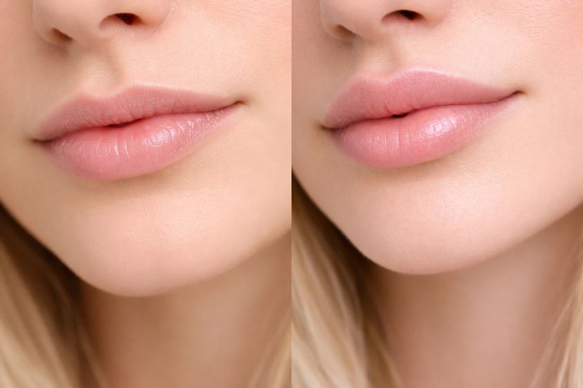 Lip Lift