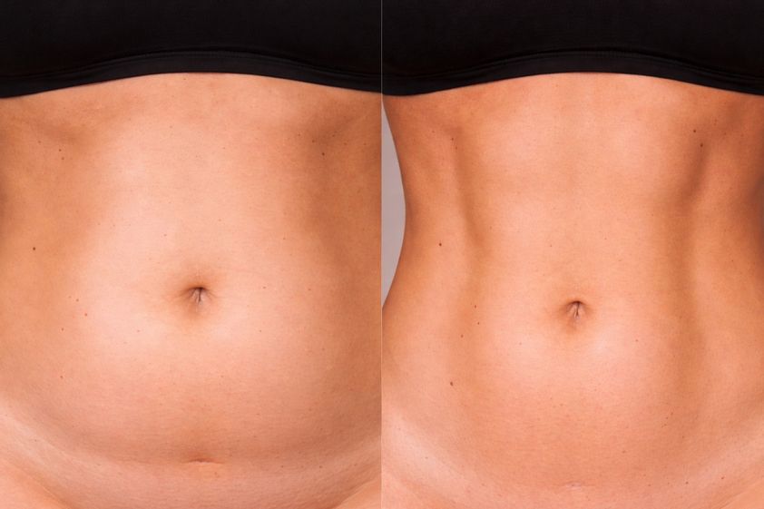 Liposukcja ultradźwiękowa