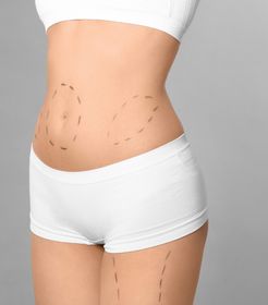 Liposukcja