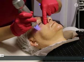 Niechirurgiczny lifting twarzy - radiofrekwencja mikroigłowa Scarlet RF