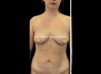 Liposukcja - Klinika Diamentum