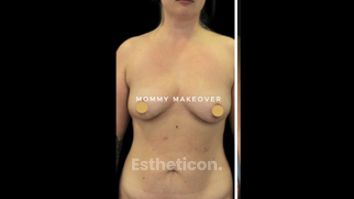 Liposukcja - Klinika Diamentum