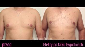 Usuwanie Ginekomastii
