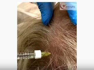 Mezoterapia owłosionej skóry głowy preparatem Dr Cyj