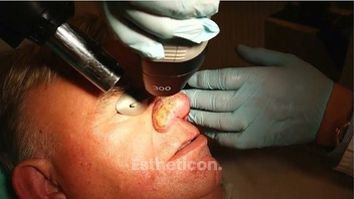 Rhinophyma laser treatment