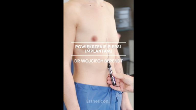 Powiększanie biustu - Klinika Diamentum