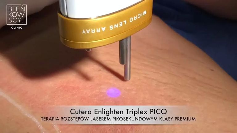 Usuwanie rozstępów laserem Cutera Enlighten PICO MLA
