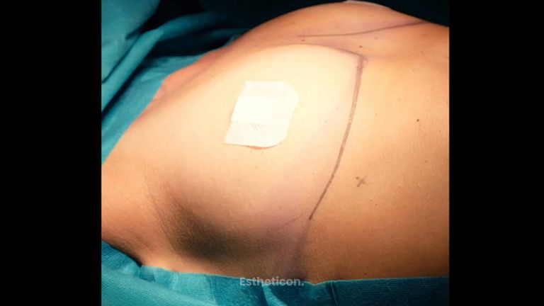 Powiększanie biustu - NawMedica - Klinika Chirurgii Plastycznej
