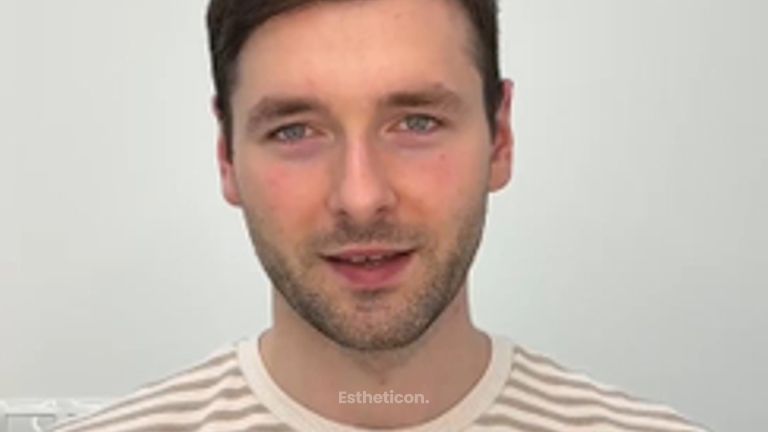 Przeszczep włosów - Efekt przeszczepu włosów w FullFace Clinic