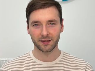 Przeszczep włosów - Efekt przeszczepu włosów w FullFace Clinic