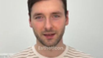 Przeszczep włosów - Efekt przeszczepu włosów w FullFace Clinic
