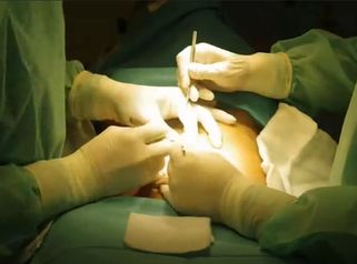 Przebieg plastyki brzucha - dr Ryszard Bratoś
