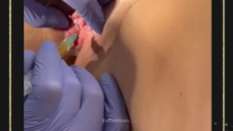O-SHOT PRP - OMEGA Estetica