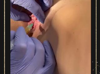 O-SHOT PRP - OMEGA Estetica
