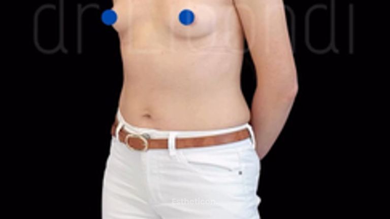 Efekt powiększania piersi implantami