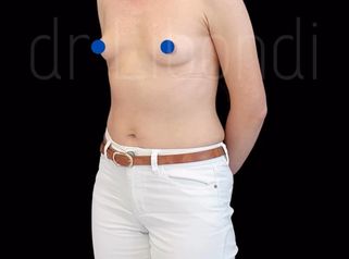 Efekt powiększania piersi implantami