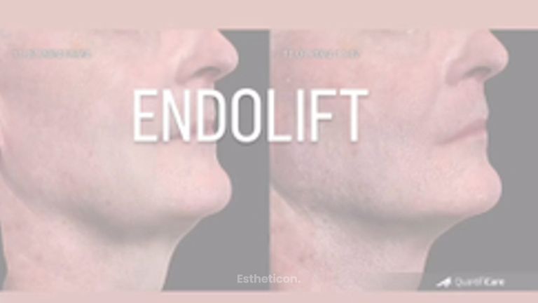 Endolift - Dr Ewa Rybicka