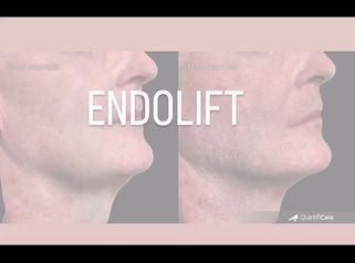 Endolift - Dr Ewa Rybicka