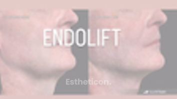 Endolift - Dr Ewa Rybicka