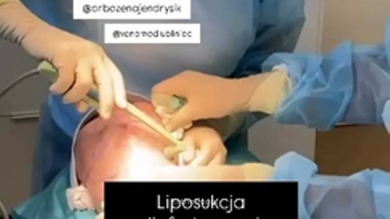 Liposukcja radiofrekwencyjna (liposukcja RF) Centrum Medyczne VENO-MED Jendrysik, Kiełek