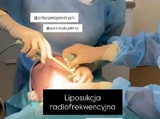 Liposukcja radiofrekwencyjna (liposukcja RF) Centrum Medyczne VENO-MED Jendrysik, Kiełek