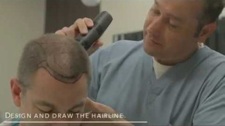 Smart Graft - Hit w walce z łysieniem