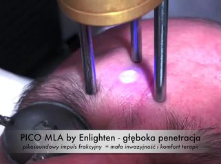 Odmładzanie i ujędrnianie skóry laserem Cutera® EnlightenTM MLA