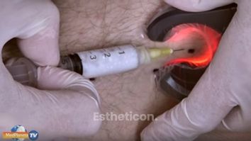 Skleroterapia