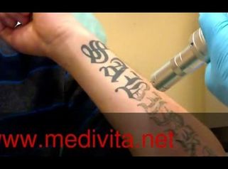 Laserowe usuwanie tatuaży (Q switch - tattoo removal)