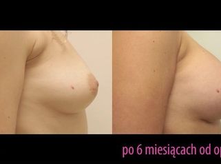 Klinika Wiatroszak - Powiększanie piersi