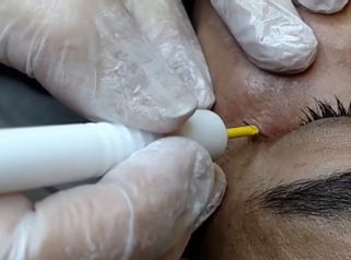 Rewitalizacja okolicy oka przy użyciu elektrody Lima 