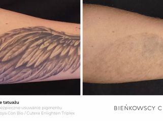 Usuwanie tatuażu i makijażu permanentnego - laser Cutera® EnlightenTM PICO + NANO technologia