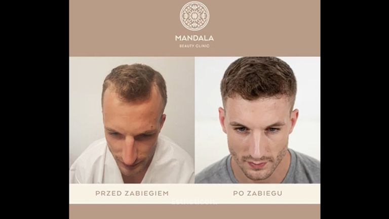Przeszczep włosów - zakola - Mandala Beauty Clinic