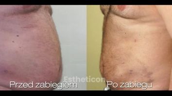 Liposukcja