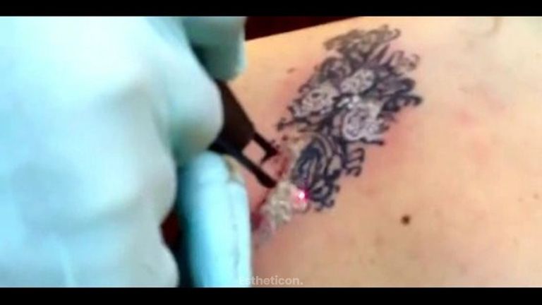 Usuwanie tatuażu wielokolorowego
